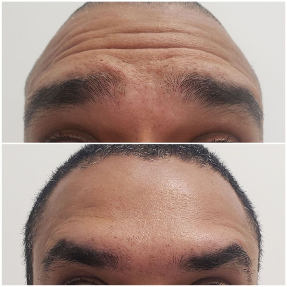 Botox