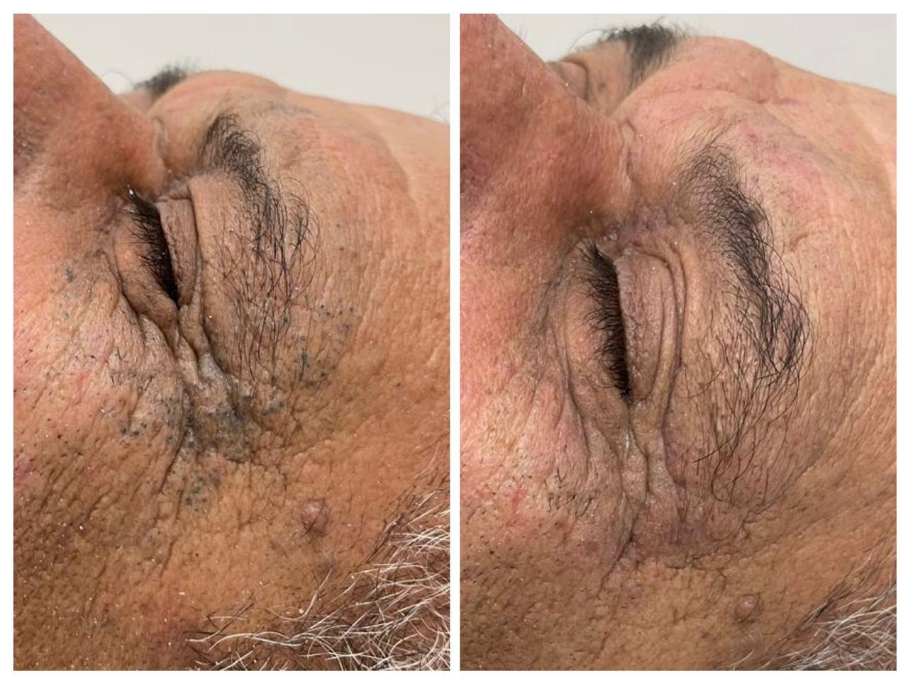 Limpeza de Pele