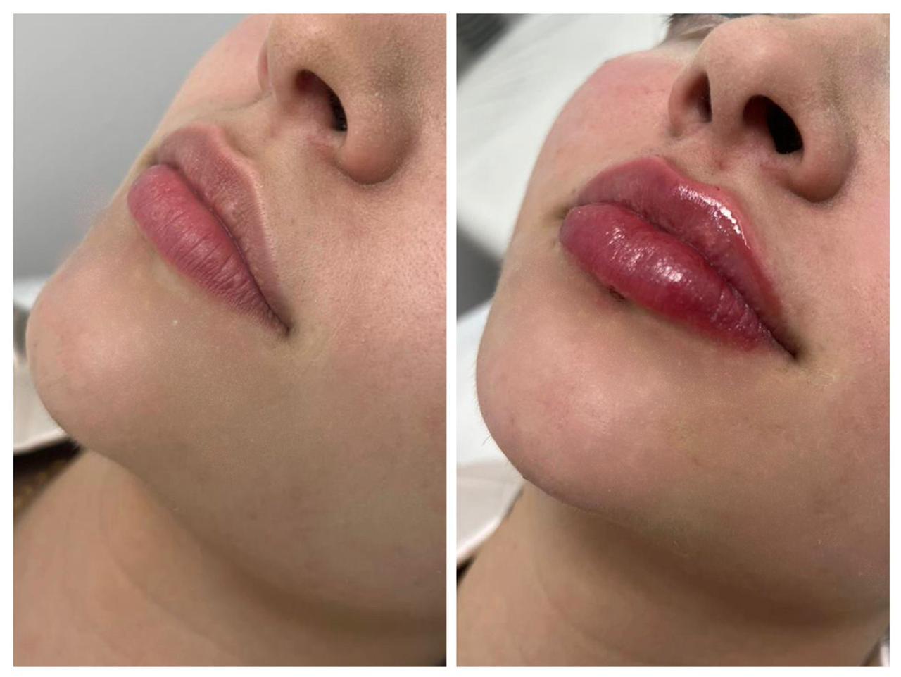 Preenchimento Labial