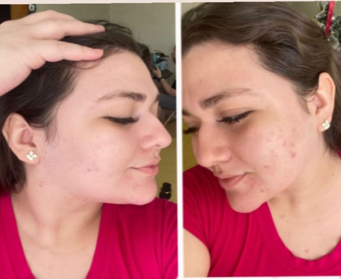 Tratamento de Acne