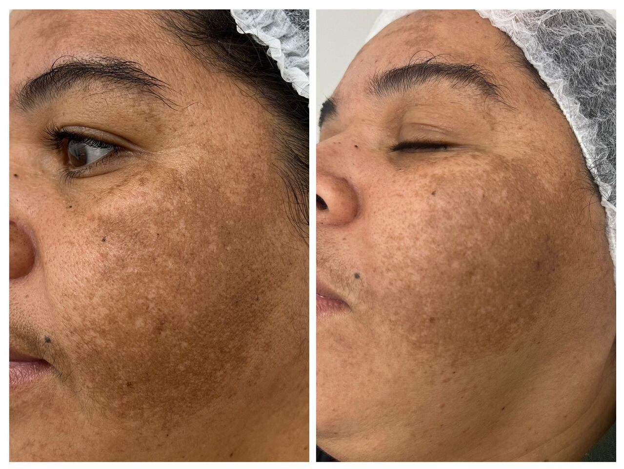 Tratamento de Melasma